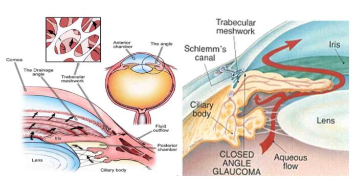 Glaucoma